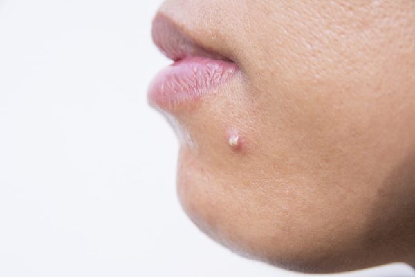 chin acne cause
